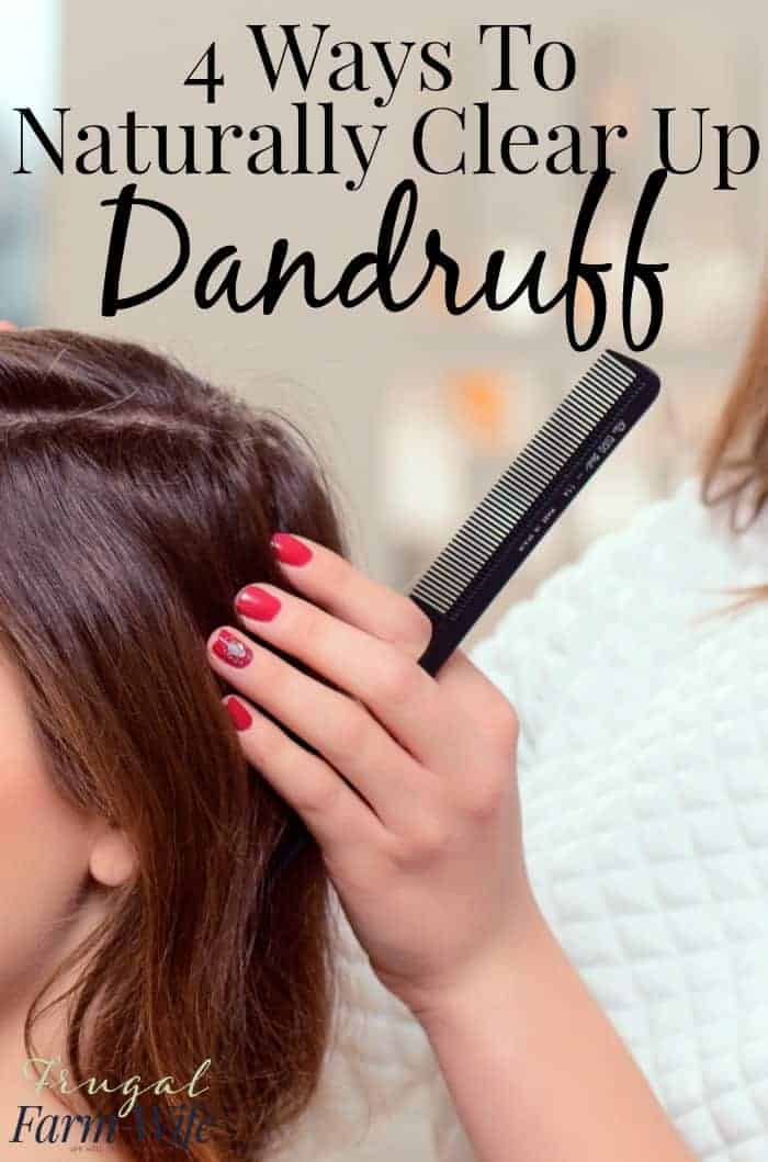 4 Ways To Clear Up Dandruff Naturally!! Frugal Farm Wife