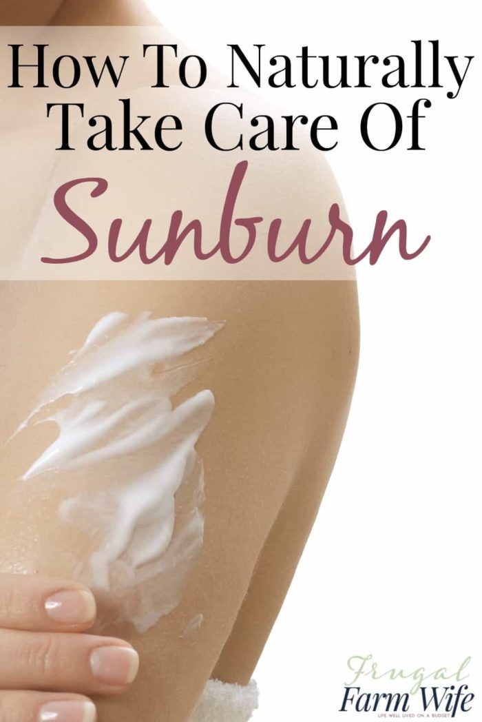 Image shows a shoulder with sunscreen and text that reads "How to Naturally Take Care of Sunburn"